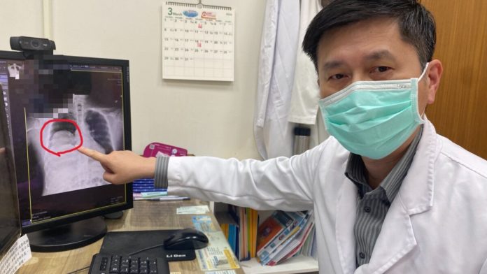 血糖狂掉到30！竟是罕見「腫瘤在偷吃糖」