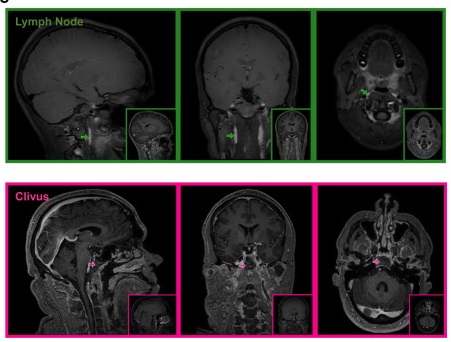 人體首次證實腦部排廢機制系統　有望改寫阿茲海默症研究