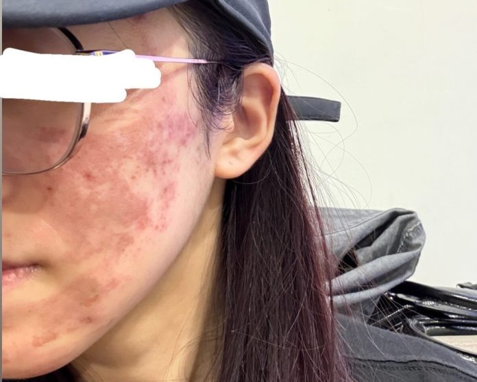 果酸換膚變毀容惡夢！高雄女慘遭 70% 高濃度灼傷　診所再被爆使用過期品
