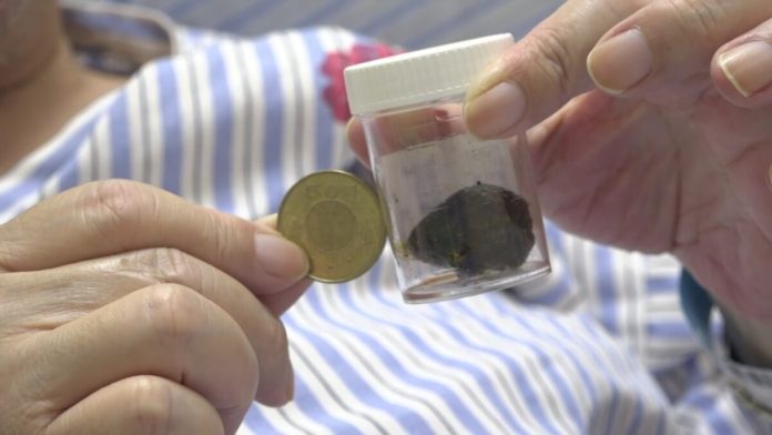 膽結石和平共存？醫：一掉進總膽管恐致命危機