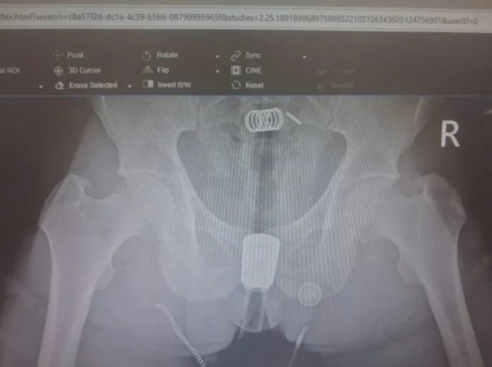 男把沖洗器塞體內卡住！X光曝光　醫急開刀救命