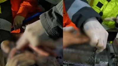 影／工安意外！巴西男「手指慘卡肉鎚機」人機送醫院麻醉拆解　保住手指免截肢