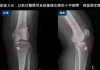 55歲婦膝蓋反覆軟腳竟是韌帶斷裂!台中醫院新式手術助保住原生膝關節 55歲婦膝蓋反覆軟腳竟是韌帶斷裂!台中醫院新式手術助保住原生膝關節