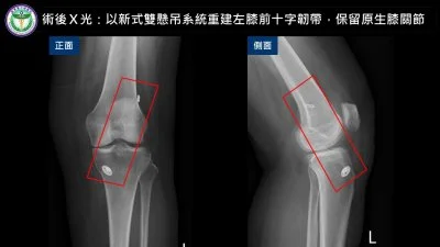 55歲婦膝蓋反覆軟腳竟是韌帶斷裂！台中醫院新式手術助保住原生膝關節